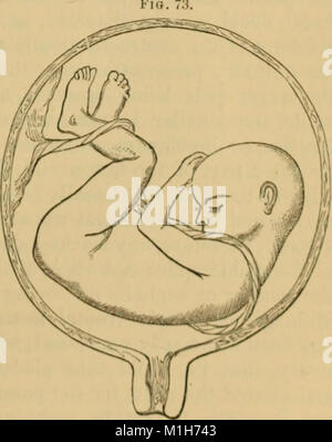 A System of midwifery - including the diseases of pregnancy and the puerperal state (1875) (14780456304) Stock Photo