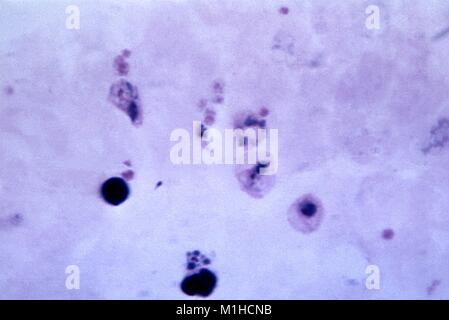 Photomicrograph of the malaria causing parasite Plasmodium vivax in its mature trophozoite stage, on thick blood film, magnified 1125x, 1965. Image courtesy CDC/Dr. Mae Melvin. () Stock Photo