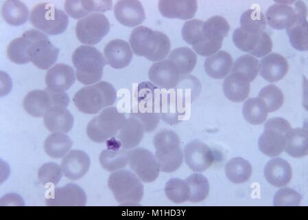 Photomicrograph of the malaria parasite Plasmodium vivax in its ring stage, with basophilic stippling in the red blood cell, on Giemsa stained thin film, magnified 1125 x, 1973. Image courtesy CDC/Dr. Mae Melvin. () Stock Photo