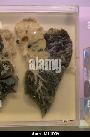 A smokers lung with carcinoma (cancer) on display in the National Museum of Health and Medicine, Silver Spring, MD, USA. Stock Photo