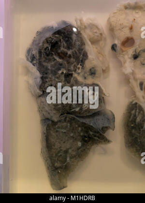 A smokers lung with carcinoma (cancer) on display in the National Museum of Health and Medicine, Silver Spring, MD, USA. Stock Photo
