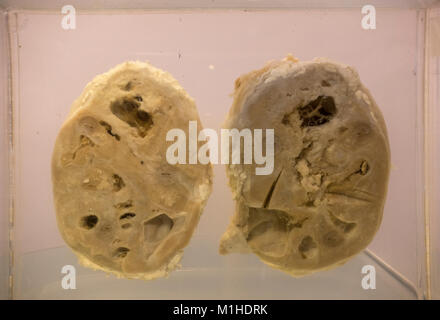 Human kidneys suffering from squamous cell carcinoma on display in the National Museum of Health and Medicine, Silver Spring, MD, USA. Stock Photo