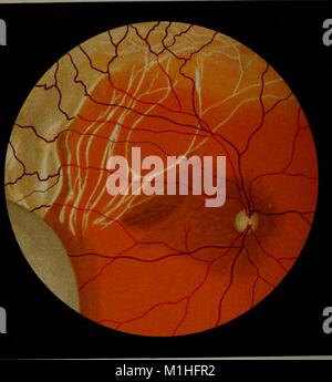 Color diagram depicting retinal bands and retinal detachment following a puncture wound to the eye, from the volume 'Atlas and epitome of ophthalmoscopy and ophthalmoscopic diagnosis, ' authored by O, 1910. (Otto) Haab and G. E. (George Edmund) De Schweinitz. () Stock Photo
