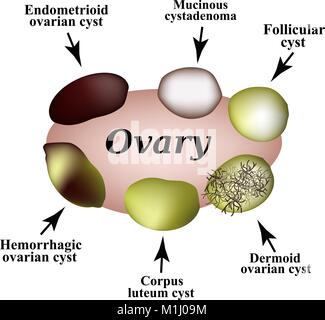 Types of ovarian cysts. Set. Infographics. Vector illustration on ...