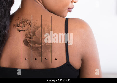 Close-up Of A Laser Tattoo Removal On Woman's Back Stock Photo