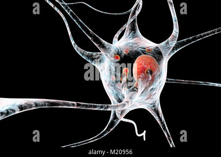 Parkinson's disease nerve cells. Computer illustration of human nerve cells affected by Lewy bodies (small red spheres inside cytoplasm of neurons) in the brain of a patient with Parkinson's disease. Lewy bodies are abnormal accumulations of protein that develop inside nerve cells in Parkinson's disease, Lewy Body Dementia, and some other neurological disorders. Stock Photo