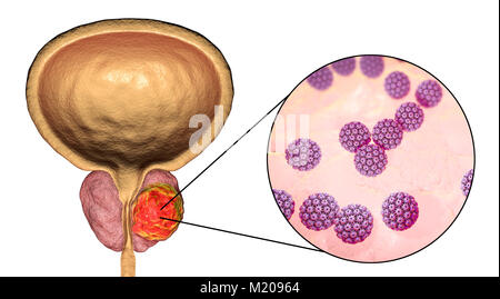 Viral etiology of prostate cancer. Conceptual illustration showing human papillomaviruses (HPV) infecting prostate gland and causing cancer development. Stock Photo