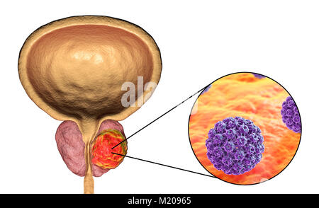 Viral etiology of prostate cancer. Conceptual illustration showing human papillomaviruses (HPV) infecting prostate gland and causing cancer development. Stock Photo