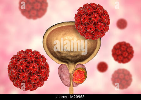 Viral etiology of prostate cancer. Conceptual illustration showing human papillomaviruses (HPV) infecting prostate gland and causing cancer development. Stock Photo