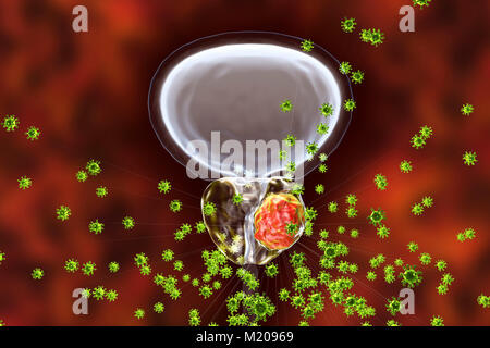 Viral etiology of prostate cancer. Conceptual illustration showing viruses infecting prostate gland and causing cancer development. Stock Photo