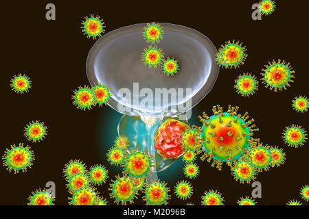 Viral etiology of prostate cancer. Conceptual illustration showing viruses infecting prostate gland and causing cancer development. Stock Photo