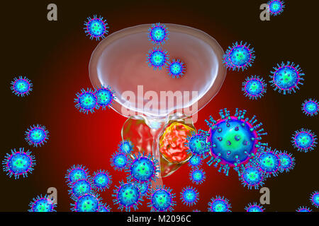 Viral etiology of prostate cancer. Conceptual illustration showing viruses infecting prostate gland and causing cancer development. Stock Photo