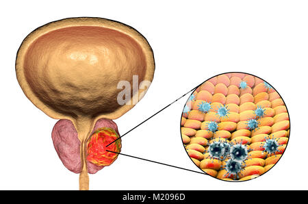 Viral etiology of prostate cancer. Conceptual illustration showing viruses infecting prostate gland and causing cancer development. Stock Photo