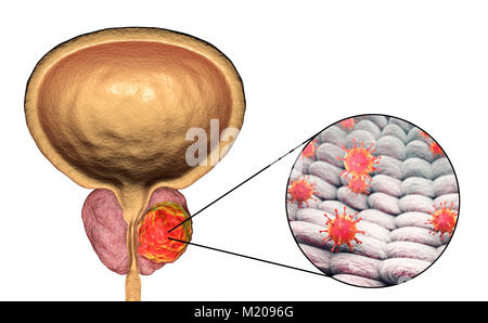 Viral etiology of prostate cancer. Conceptual illustration showing viruses infecting prostate gland and causing cancer development. Stock Photo