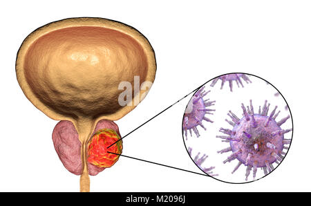 Viral etiology of prostate cancer. Conceptual illustration showing viruses infecting prostate gland and causing cancer development. Stock Photo