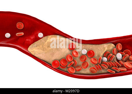 Atheromatous plaque inside blood vessel, computer illustration. A cholesterol atheroma is causing a narrowing of an artery (atherosclerosis). Stock Photo