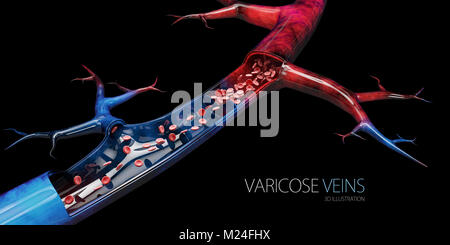 Disease varicose veins, 3d illustration isolated black. Stock Photo