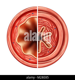 Asthma bronchial tube constricted breathing  problem concept caused by respiratory muscle tightening  and swelling of air passage. Stock Photo