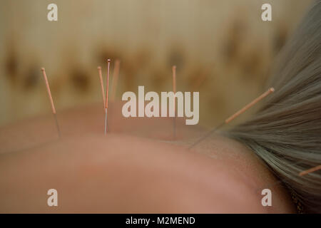 Young woman getting acupuncture treatment in therapy room. Female patient undergoing acupuncture treatment, closeup. Soft focus Stock Photo