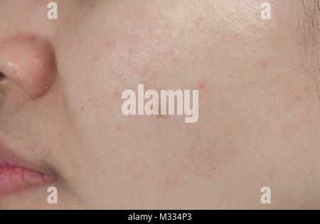 Acne spot on face skin of Asian woman. Concept before face laser treatment for get rid of dark spot post-acne. Stock Photo