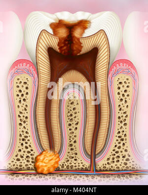 Caries in degenerative and infectious phases in which you can see the pulp inflated with abscess. Caries is characterized by the chemical destruction Stock Photo