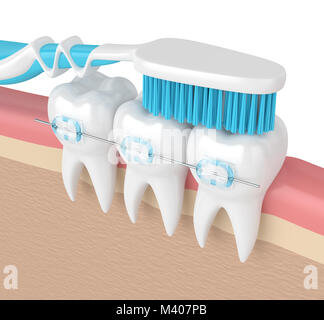 3d render of teeth with ceramic braces and toothbrush isolated over ...