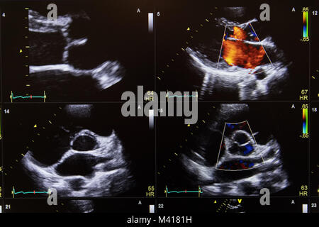 Heart ultrasound image on a computer screen. Stock Photo