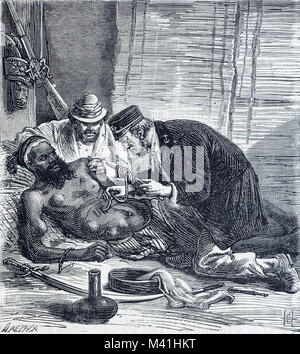 European Doctor Treating African Man Infected by and Being Treated for Guinea Worm, Dracunculiasis medinensis. The doctor extracts the worm by winding it around a stick which may be the origin of the medical symbol of the Rod of Asclepius. (Engraving 1879) Stock Photo