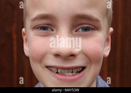 Closeup of boy with braces Stock Photo