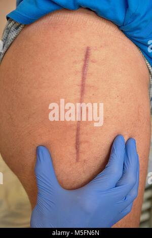 Hip Replacement Surgery Scar Stock Photo - Download Image Now