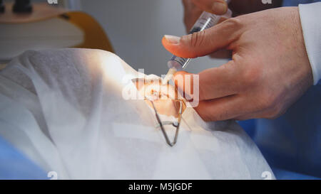 Laser correction for vision - ophthalmology surgery, doctor swab rubs the eyeball Stock Photo