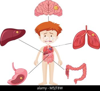 Boy and diagram showing different parts of organs with disease illustration Stock Vector