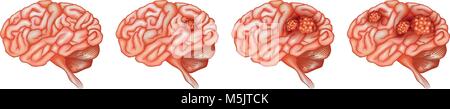 Different stages of cancer in brain illustration Stock Vector