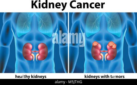 Diagram showing kidney cancer in human illustration Stock Vector