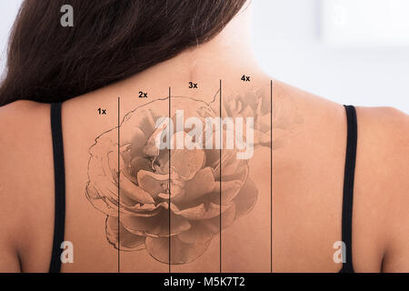 Close-up Of Laser Tattoo Removal On Woman's Back Against White Background Stock Photo