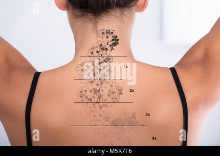 Laser Tattoo Removal On Woman's Back Against White Background Stock Photo