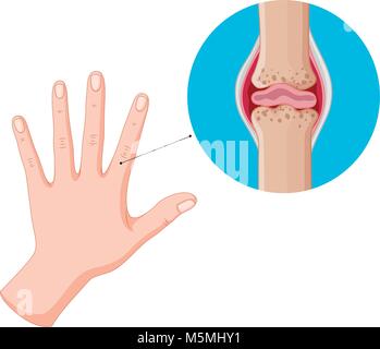 Human hand and bad joints illustration Stock Vector