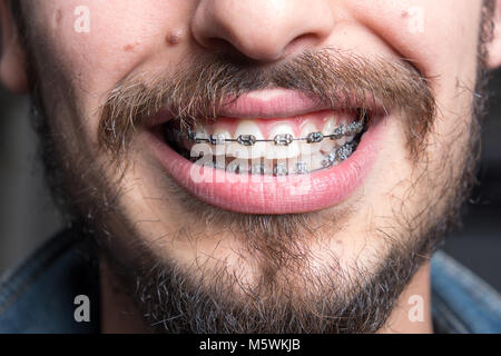 Young man with braces Stock Photo