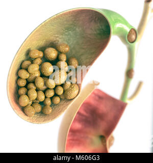 Gallstones in gallbladder and bile duct - high details - 3D rendering Stock Photo