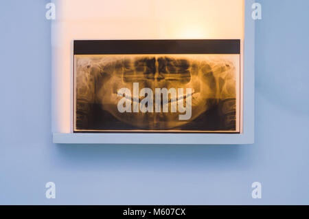 Analyzing dental x-ray, tooth x-ray in viewer on the wall. Stock Photo