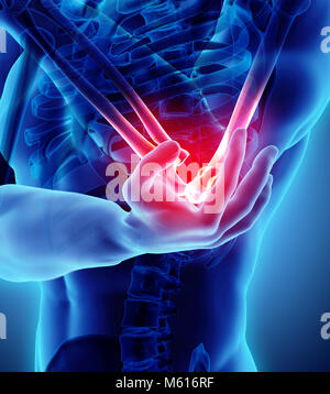 3d illustration of human elbow injury, medical concept. Stock Photo