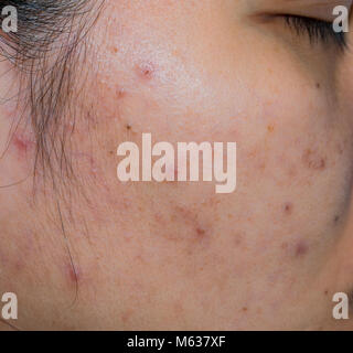 Acne and acne spot on oily face skin of Asian woman. Concept before acne treatment and face laser treatment for get rid of dark spot post-acne. Closed Stock Photo