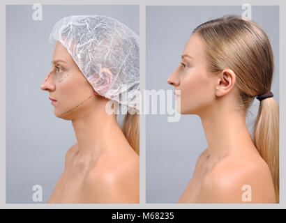 Rhinoplasty. Portrait of female face, before and after plastic surgery of the nose Stock Photo