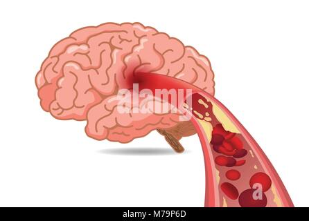 Cholesterol in veins made slow blood flow into brain. Stock Vector