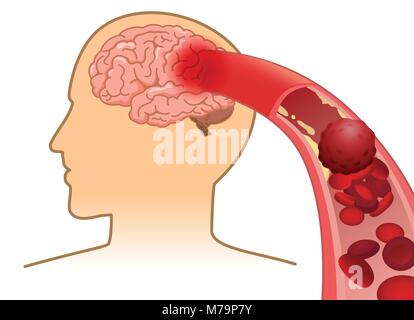 Blood cell can't flow into human brain because clogged arteries by blood clot. Stock Vector
