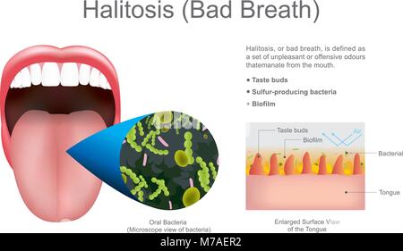 Halitosis or bad breath. Education info graphic. Vector design. Stock Vector