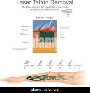 Is Tattoo Removal a Good Investment for my Aesthetics Practice?