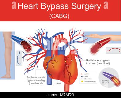 A plaque it is blocked artery cause reduces blood flow. A new blood as applied from another part of your body. Illustration human anatomy. Stock Vector