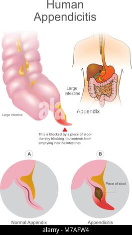 Human Appendicitis. A blocked by a piece of stool thereby blocking it is contents from emptying into intestines. Large Intestine system. Illustration  Stock Vector