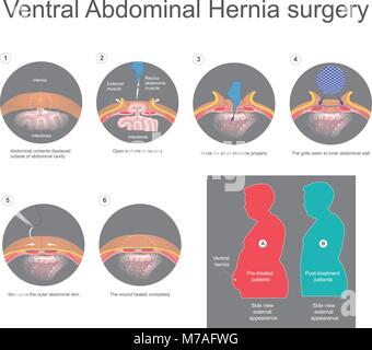 Ventral hernia is a bulge of tissues through an opening of weakness within your abdominal wall muscles. Info graphic vector. Stock Vector